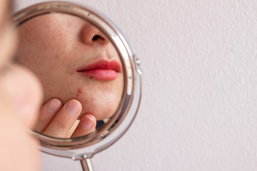 Managing PCOS-Related Skin Issues: Acne, Oily Skin, and Hirsutism